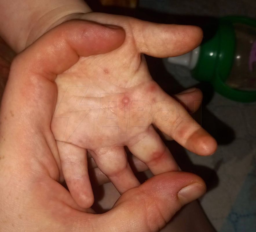 Вирусом Коксаки массово заражаются дети по всей России: болезнь приносят из детских садов