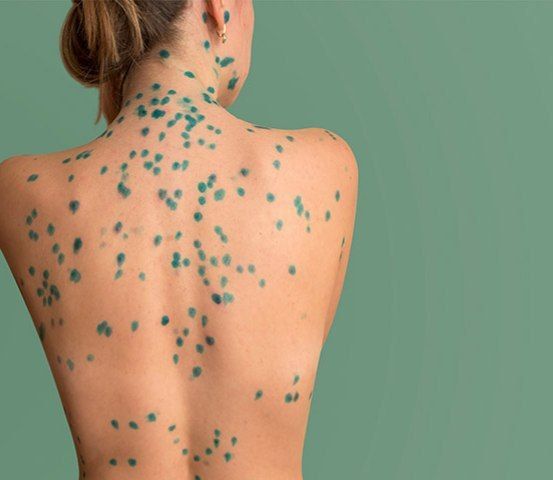 Ветрянка стремительно распространяется по России — во многих регионах резкий рост заболеваемости